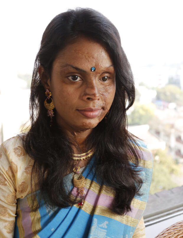 In 1998, Monira Akter was attacked with acid and her life was changed forever in an instant. The left side of her face and the upper part of her body was badly burnt. She was only 9 years old at the time. The Acid Survivors Foundation (ASF) arranged for Monira to travel to Spain for reconstructive surgery. Picture: Ricci Coughlan/DFID